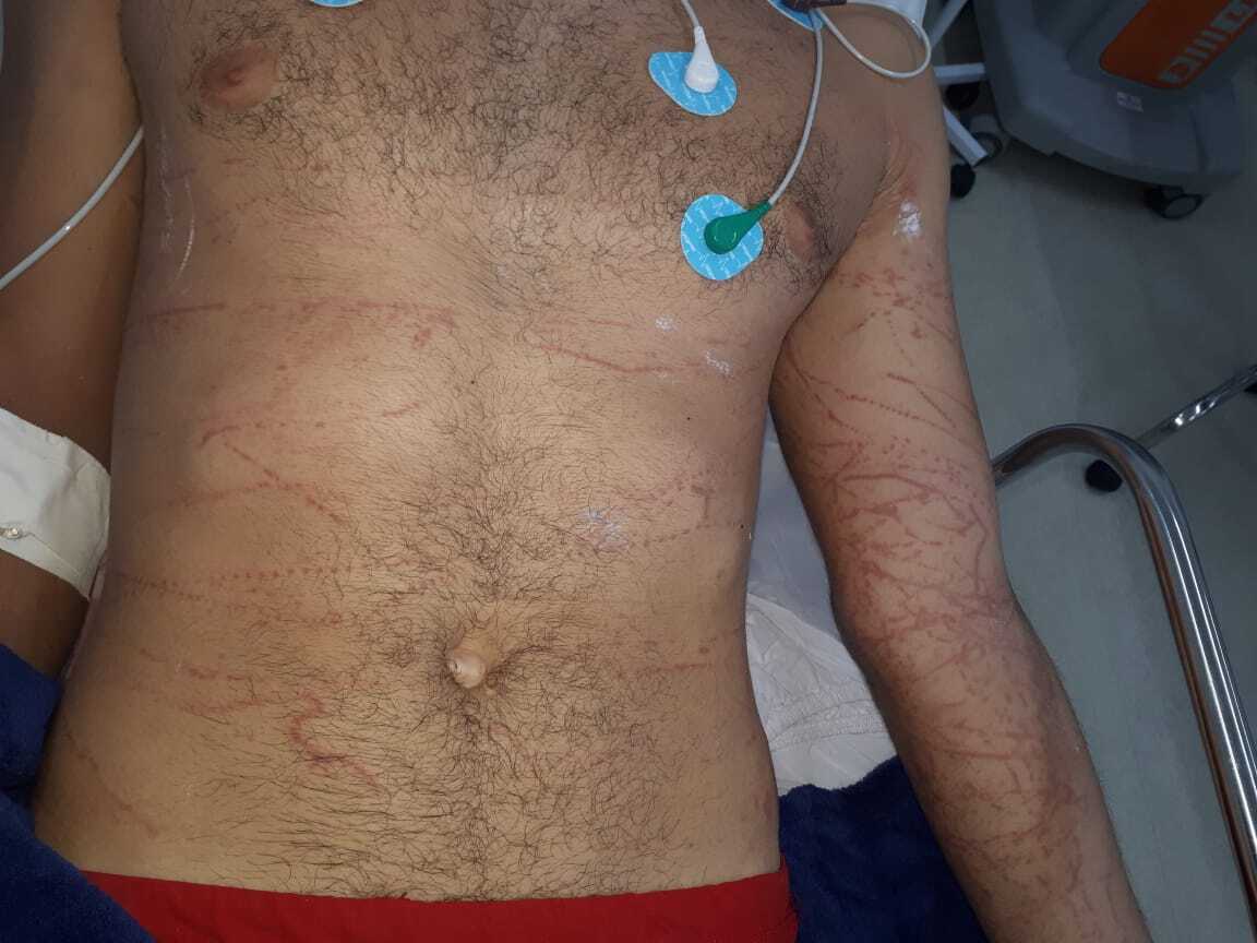 Nadador envenenado por caravela é levado às pressas para hospital no PR