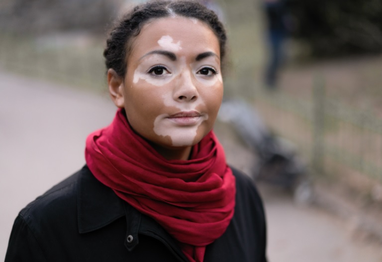 Vitiligo: uma doença ainda rodeada de desinformação e preconceito